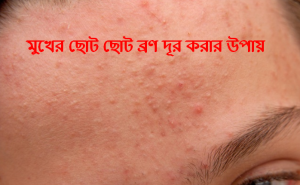 মুখের ব্রণ দূর করার উপায়